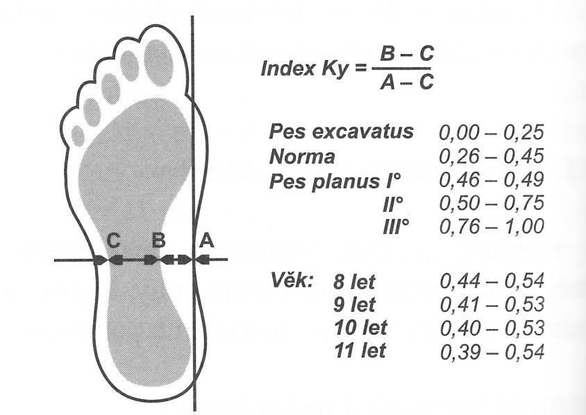 Obrázek 16. Metoda pro hodnocení podélné klenby nožní podle Sztritera-Godunova (Kasperczyk, 1998). 3.