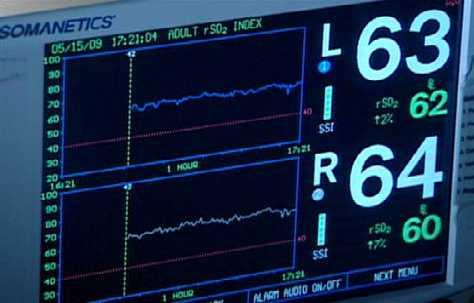 Neuromonitorování NIRS, near infrared spectroscopy: - regionální množství okysličeného