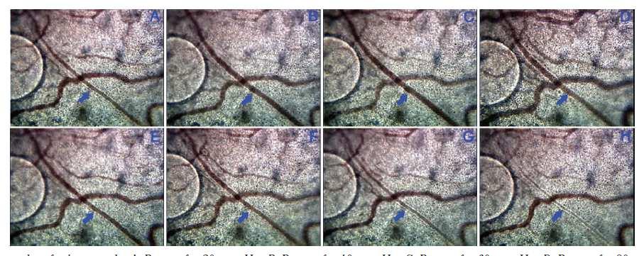 100 mmhg 125