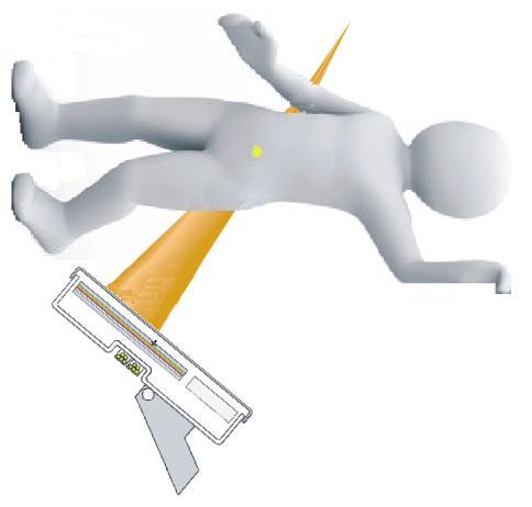 Obrázek č. 4: Ozáření pacienta při natočení gantry o úhel theta. Žlutý bod značí izocentrum. Obrázek č.