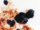 roztok methylénové modři (v ethanolu s kyselinou octovou) a krystalové violeti (2:1) 2. Bismarckova hněď vodný roztok Neisserovo barvení 1. krystalová violeť reaguje s kyselými složkami protoplasmy 2.