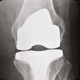 For the past 30-years, total knee instruments