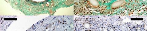(B) Foam cells in the intima of an