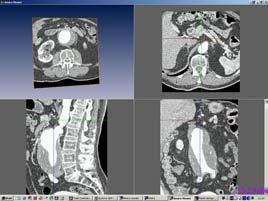 The 3 rd European Medical and Biological Engineering Conference November 20 25, 2005 EMBEC'05 Prague, Czech Republic Pulsatile velocity boundary condition The inlet boundary condition of continuum