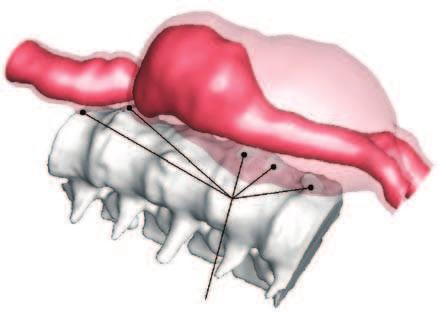 ANEURYSMS BIOMEDICAL INDUSTRY areas where artery wall touches vertebrae Model of the abdominal aortic aneurysm and nearby vertebrae without the peripheral branches stress redistribution can be