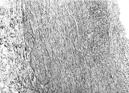 Inflammation in AAA and its role in the symptomatology of aneurysm N 93 Figure 1 Normal structure of an abdominal aorta from cadaveric donor (control group).