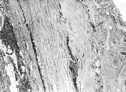 Figure 2 The severe disorganization of all layers of the wall in asymptomatic aneurysm of abdominal aorta. Inflammatory infiltration without lymphoid follicle formation. MGT, 100X.