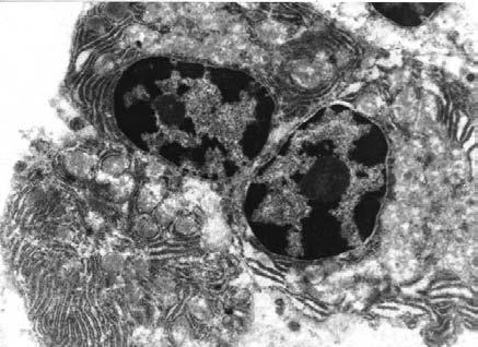 In patients with AAA rupture, the cytosolic concentrations of IL-6, IL-8 and TNF-a were significantly higher (p B/0.0001, p B/0.003 and p B/0.