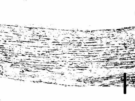 Capillary electrophoresis determination of huperzine A In the samples of AAA, there was very much in evidence the disintegration and chaotic rearrangement of the tissue and disappearance of the