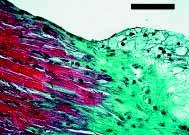 thickening of the coronary artery intima (4) and atherosclerotic plaque in the aortic valve (5,6,7).