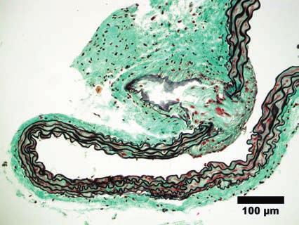 Plate II Fig. 5. Sample No. 1 (Group 1). A lesion comparable to human type II contains macrophages covered by a fibrous cap.
