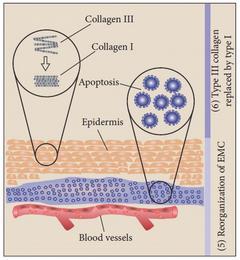 3. REMODELACE Remodelace kolagenu Vaskulární regrese Většina chronických ran jsou vředy z důvodu ischemie, diabetu, venostázy,