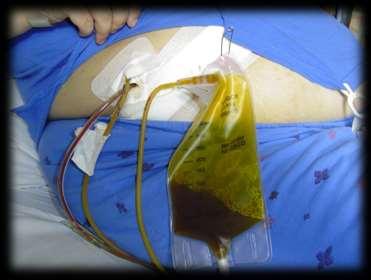 T-DRÉN PO OP CHCE http://i01.i.aliimg.com/photo/v1/60006506377/latex_t_drainage_tube.jpg http://www.pilgrimshospital.