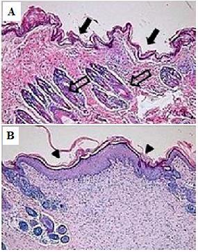 vaskularizovaného kožního štěpu může být výhodné i podání MSC společně s buňkami kostní dřeně dárce (BMC, bone marrow cells).