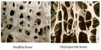 nad 70 let. Celkově osteoporóza posthuje více než 5 % obyvatel.