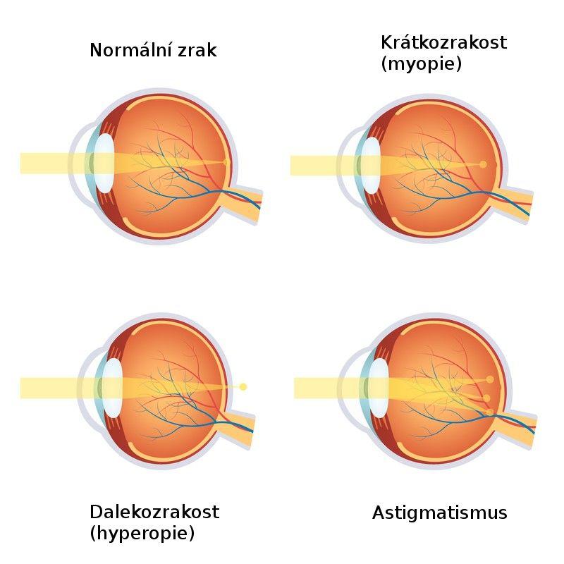 Vady zraku Barvoslepost je sice vada oka, ale neprojevuje se při vedení světla.