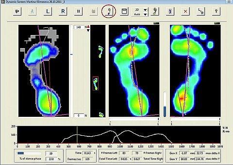 5.3 Zpracování dat Námi naměřené údaje byly nejprve zpracovány v programu Footscan Gait.