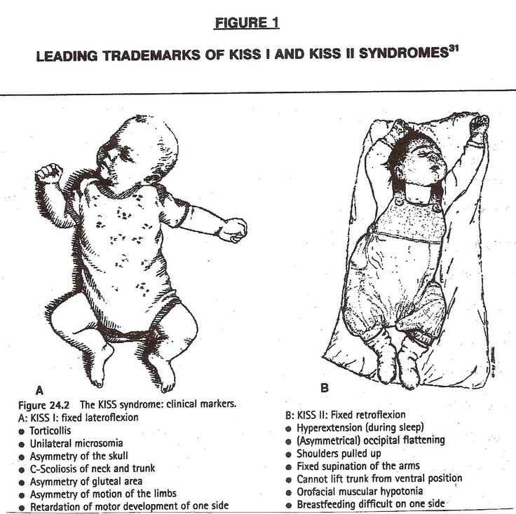 3 KISS I a KISS II. (Zdroj: Rosner, 2003) Obrázek 6 popisuje rozdílné příznaky u KISS I. a II. Typu.