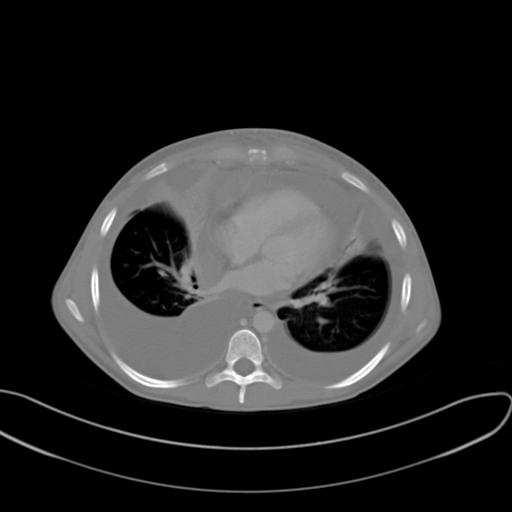 Dopad na ventilaci, oxygenaci a - Ppl jako determinanta hemodynamiku transpulmonálního tlaku potřebného k