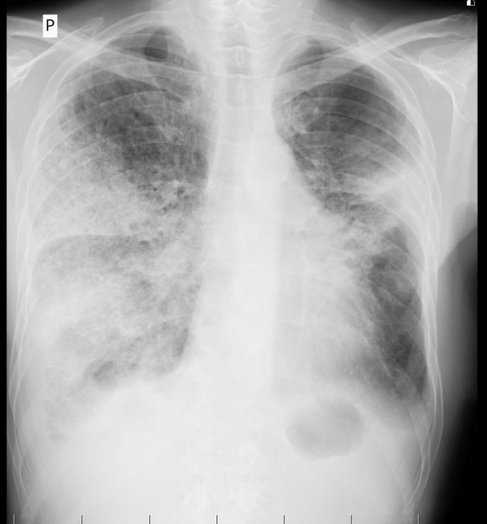 Léčba na JIP: Ihned oxygenoterapie (vysoké průtoky maskou) Ihned podán 1g SoluMedrolu 1g SoluMedrolu po 4 dny, pak rychlé snižování dávek Zahájena ATB terapie Meropenemem 1g á 8h, 7 dní Předpokládali