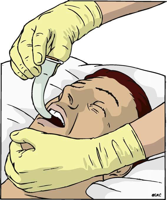Zavést za probíhající masáže Intubace