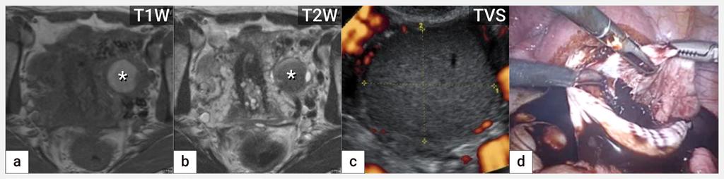 Obr. 3 Endometroidní cysta Zobrazení endometroidní cysty v magnetické rezonanci na podkladě přítomnosti rozpadových produktů hemoglobinu, která je v T1 váženém obrazu hyperintenzní (zvýšený signál)