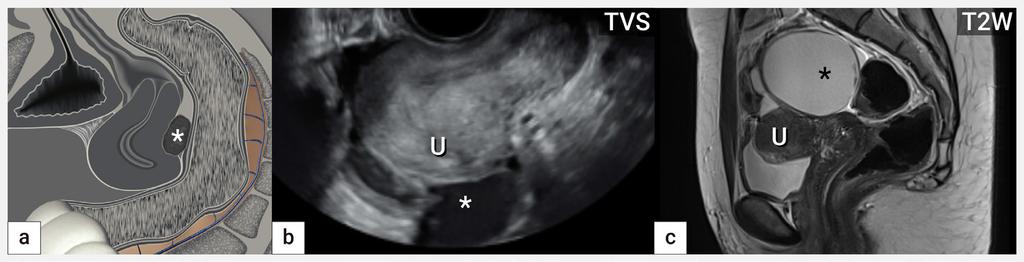 Tab. 1 Stanovení posunlivosti orgánů během ultrazvukového vyšetření Zobrazovací metoda Senzitivita (%) Specificita (%) Autor, rok Pohyblivost orgánů (sliding sign) 83 85 97 96 Reid, 2013 [17]
