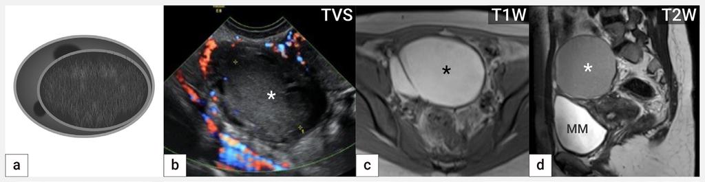 Obr. 1 Endometroidní cysta Schéma endometroidní unilokulární hladkostěnné cysty s tekutým obsahem vzhledu mléčného skla intraovariálně (a), ultrazvukový nález unilokulární cysty (hvězdička) s obsahem