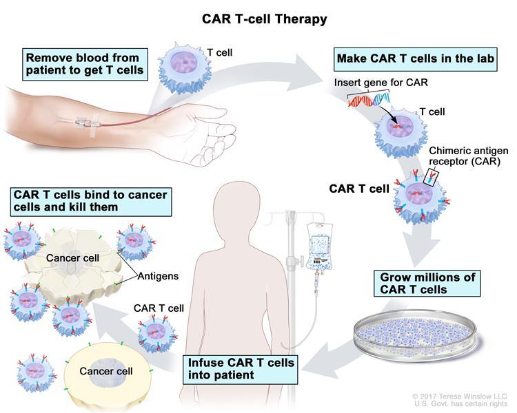 CAR-T Zdroj: https://www.cancer.