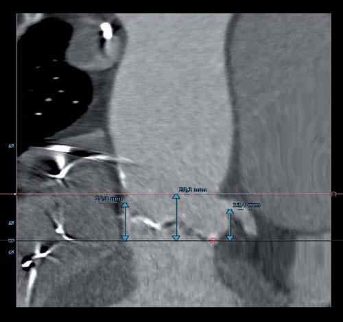 chlopně samoexpandibilní, jež využívají tvarovou paměť nitinolu (CoreValve a nověji CoreValve Evolut R dodávané firmou Medtronic).