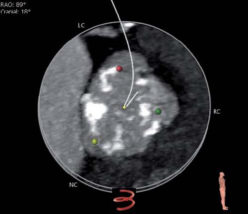 68 CoreValve Evolut R u funkčně bikuspidální aortální chlopně Obr.