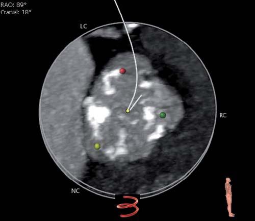 68 CoreValve Evolut R u funkčně bikuspidální aortální chlopně Obr.