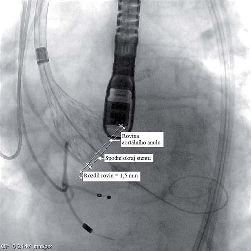 P. Kmoníček, M. Mates 69 Rozdíl rovin = 1,5 mm Rovina aortálního anulu Spodní okraj stentu Obr.