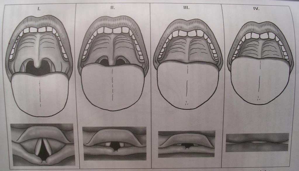 Příloha 5 Klasifikace obtížné intubace Zdroj: LUKÁŠ, J.