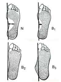 konvexita vnitřního okraje chodidla. Adamec uvádí plantogram nohy ve stoji s viditelným rozloţením zátěţe do tří stupňů. Toto rozdělení ukazuje obrázek č. 10 (ADAMEC, 2001). Obr.