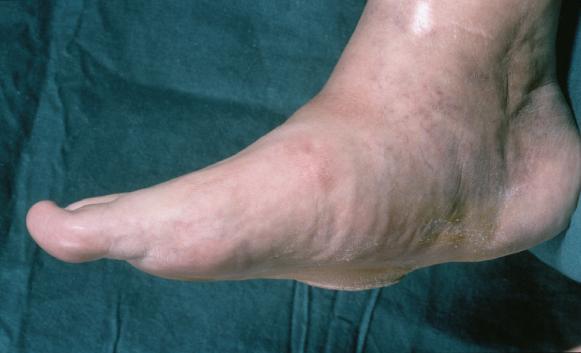 edému. Při současné osteolýze nebo lokální osteoporóze lze také zvážit podávání rekalcifikační léčby.