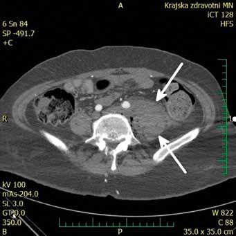 5a 5b 5 (a) CT s hematomem v retroperitoneu vlevo (šipky) (a) CT with retroperitoneal hematoma on the left side (arrows) (b) Katetrizační angiografie, pseudoaneurysma a.
