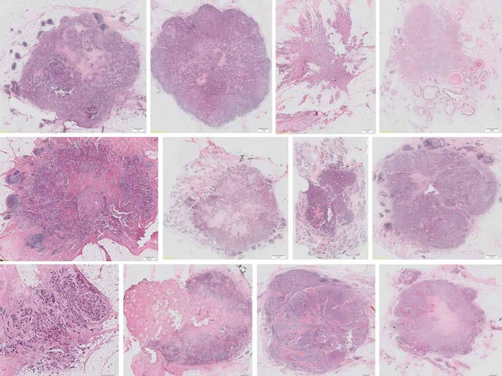 Obr. 1. Ukázka typické morfologie karcinomů prsu našeho souboru. Barveno hematoxylinem a eozinem. tistics version 23.0 (IBM SPSS, Armonk, NY, USA).