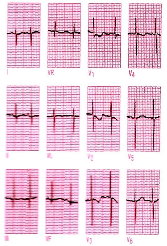 EKG A VĚK novorozenec: - frekvence 160/ min, akce nepravidelná - sklon osy doprava - negativní T ve V1-4 2 roky: - klesá frekvence (150/ min) - normální sklon osy - negativní T ve V1 2 10 let: