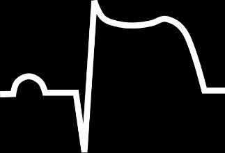 STEMI (ST-elevation myocardial infarction), Q infarkt myokardu normální EKG akutní IM (minuty - desítky hodin) Vysoká hrotnatá vlna T = první projev STEMI Vysoká hrotnatá vlna T + elevace ST =