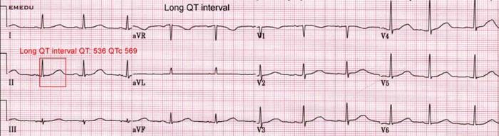 Syndrom prodlouženého QT intervalu Interval QT hodnotíme jako korigovaný dle tepové frekvence: QTc QTc=QT/ R-R Prodloužený QTc je nad 450 ms.