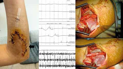 258 Hlavná téma Obr. 1. Krátká kazuistika dětské pacientky s úrazem levé horní končetiny a poraněním n. ulnaris (pád do skleněných dveří).