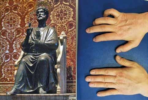 Hlavná téma 261 Obr. 5. Příznak žehnající ruky Benediction posture vznikající u obrny ulnárního nervu (socha sv. Petra od Arnolfa di Cambia, bazilika sv. Petra v Římě) Obr. 6.