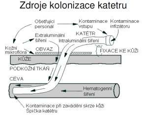 nebo výměně) ke kultivačnímu vyšetření do mikrobiologické laboratoře. V případě, že katétr není pravděpodobně zdrojem infekce, není nutné jej měnit.