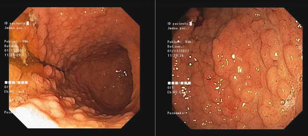 GAPPS GASTRIC ADENOCARCINOMA AND PROXIMAL POLYPOSIS OF THE STOMACH SYNDROME Fig. 9.
