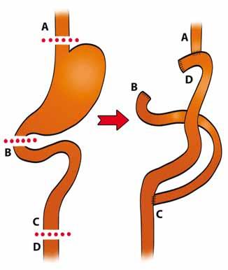 GAPPS GASTRIC ADENOCARCINOMA AND PROXIMAL POLYPOSIS OF THE STOMACH SYNDROME Fig. 11.