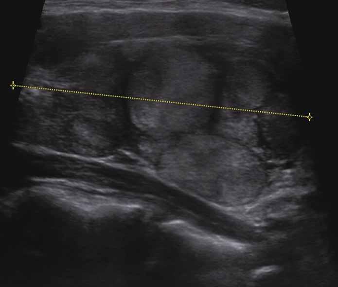 SYNDROM DICER1 nefromu v raném dětství předpovídá nižší pravděpodobnost pozdější renální malignity [9].
