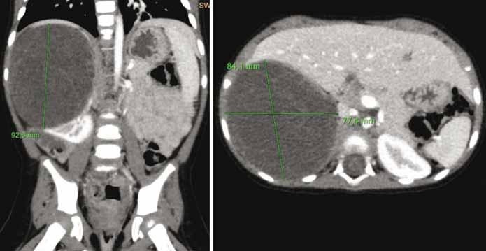 SYNDROM DICER1 A B C Obr. 2. Vyšetření pacientky z kazuistiky 2. A. Rentgen hrudníku. B, C. Počítačová tomografie plic pleuropulmonální blastom v době stanovení diagnózy. Obr. 3.