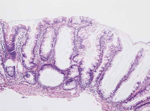 Do spektra serrated lézí patří: a) hyperplastické polypy morfologicky lze definovat tři subtypy, pravděpodobně bez klinického významu jsou tvořeny paralelně uspořádanými kryptami s povrchově