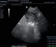 Röntgen ve ultrasonografik muayenelerinde farklı çaplarda (0,49-0,93 cm) 4 adet